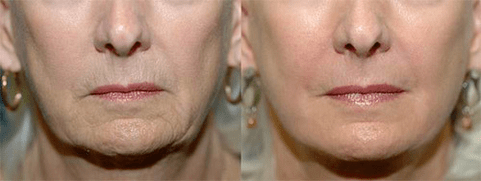 Terapia laser prima e dopo