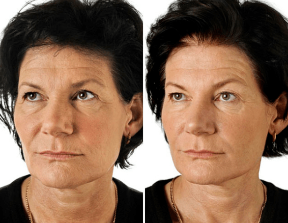 Il risultato del ringiovanimento frazionario del viso