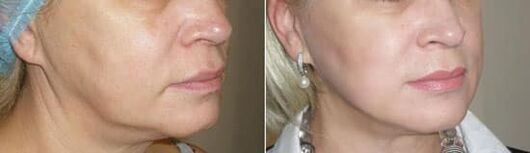 Foto dopo l'applicazione della procedura