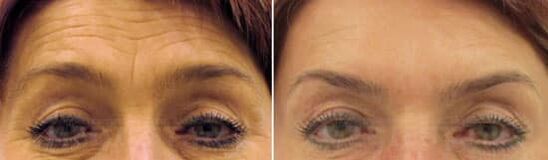 Ringiovanimento del campo della fronte