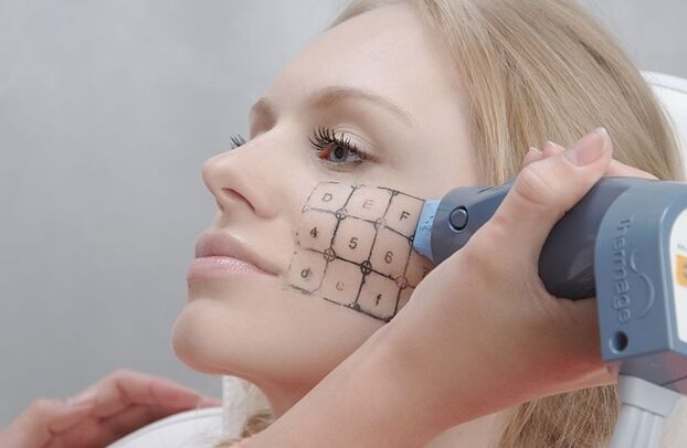 Procedura di Thermage