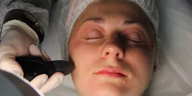 Come prepararsi al ringiovanimento cutaneo al plasma