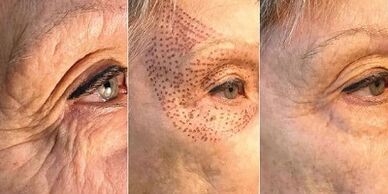 Foto prima e dopo il ringiovanimento cutaneo al plasma